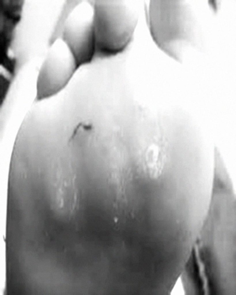 calluses
